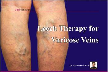 Leech Therapy for Varicose Veins